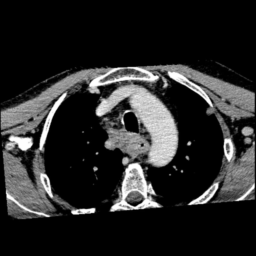 Anaplastic thyroid carcinoma (Radiopaedia 79087-92034 B 9).jpg