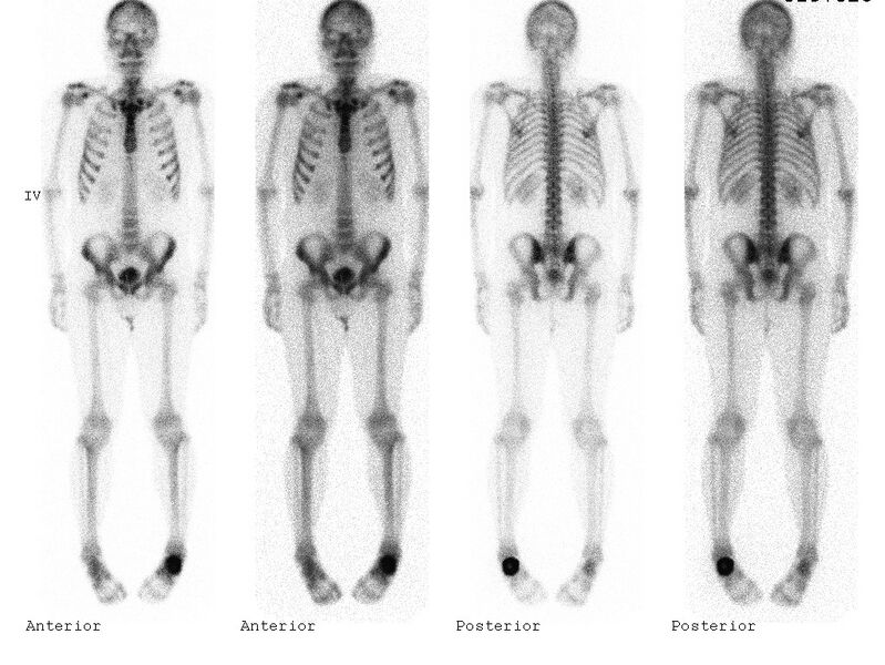 File:Aneurysmal bone cyst of the calcaneus (Radiopaedia 60669-68419 D 1).jpg