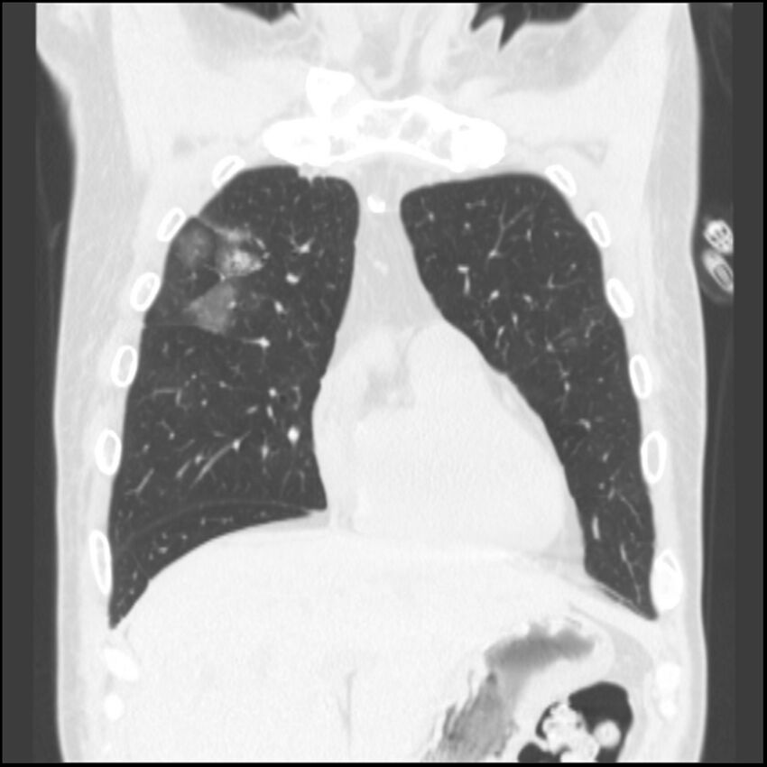 Angioinvasive aspergillosis (Radiopaedia 43957-47466 Coronal lung window 70).jpg