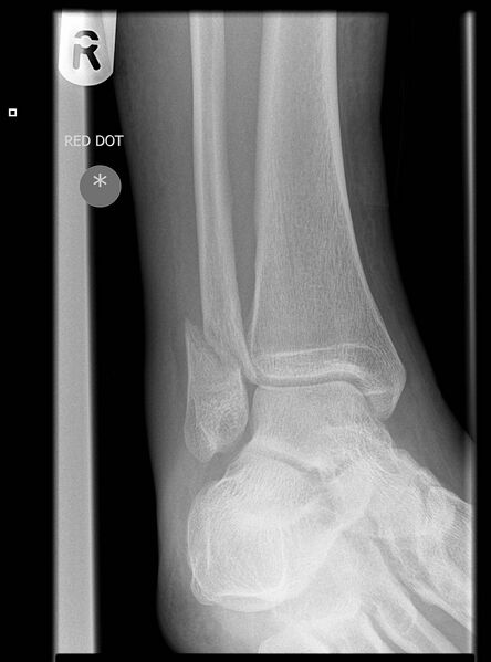 File:Ankle fracture - Weber B (Radiopaedia 8787-9588 Oblique 1).jpg