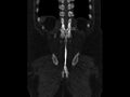 Ankylosing spondylitis (Radiopaedia 44609-48357 Coronal bone window 89).jpg