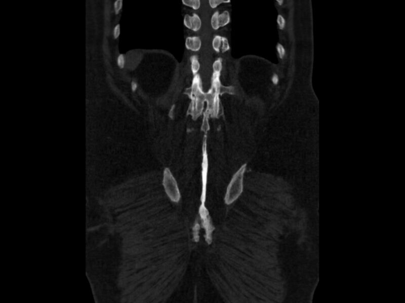 File:Ankylosing spondylitis (Radiopaedia 44609-48357 Coronal bone window 89).jpg