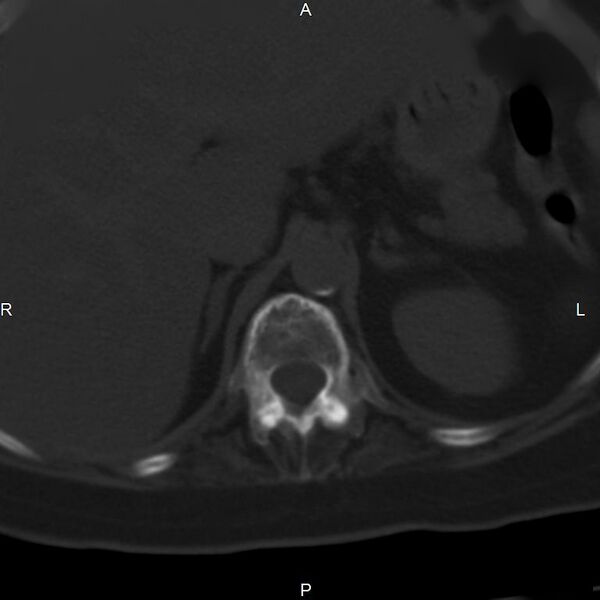 File:Ankylosing spondylitis (Radiopaedia 8748-9556 Axial bone window 15).jpg