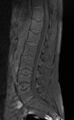 Ankylosing spondylitis - Andersson lesion (Radiopaedia 81878-95838 Sagittal T1 fat sat 7).jpg
