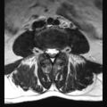 Ankylosing spondylitis with zygapophyseal arthritis (Radiopaedia 38433-40516 Axial T2 9).jpg