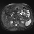 Annular pancreas (Radiopaedia 38292-40320 Axial T2 fat sat 7).png