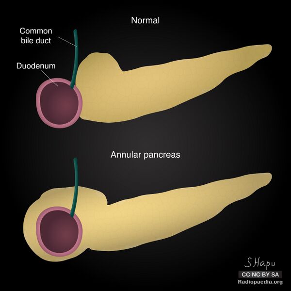 File:Annular pancreas (illustrations) (Radiopaedia 55824-62411 Axial 1).jpg