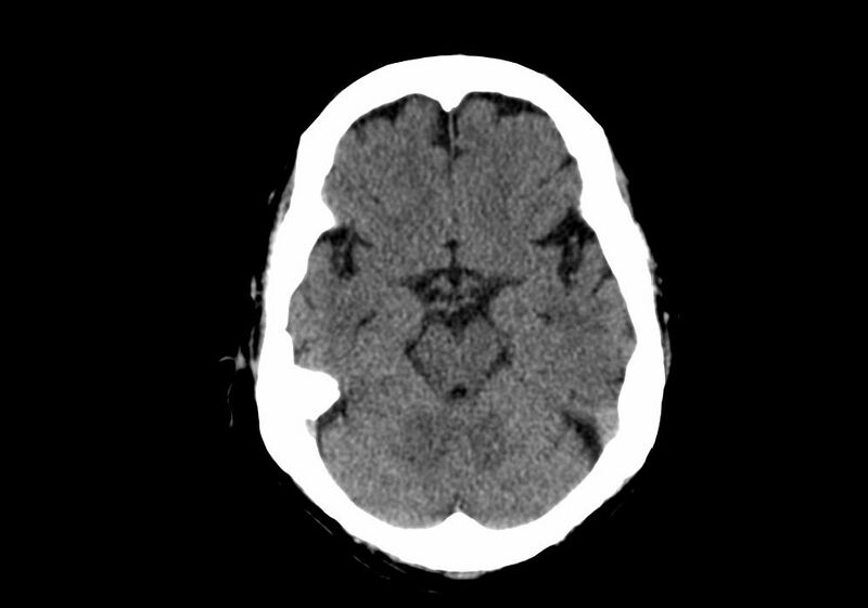 File:Anomalous intracranial venous drainage (Radiopaedia 28161-28418 Axial non-contrast 15).jpg