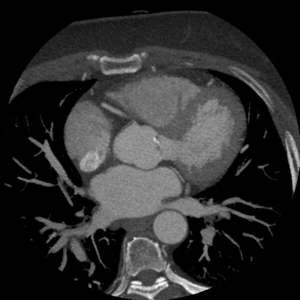 File:Anomalous origin of left circumflex artery from right coronary sinus (Radiopaedia 72563-83117 A 36).jpg