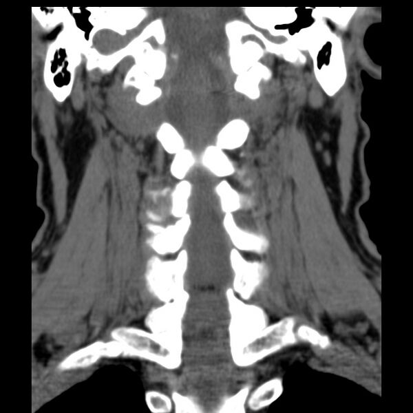 File:Anterior cervical postdiscectomy arthrodesis (Radiopaedia 32678-33646 Coronal non-contrast 21).jpg