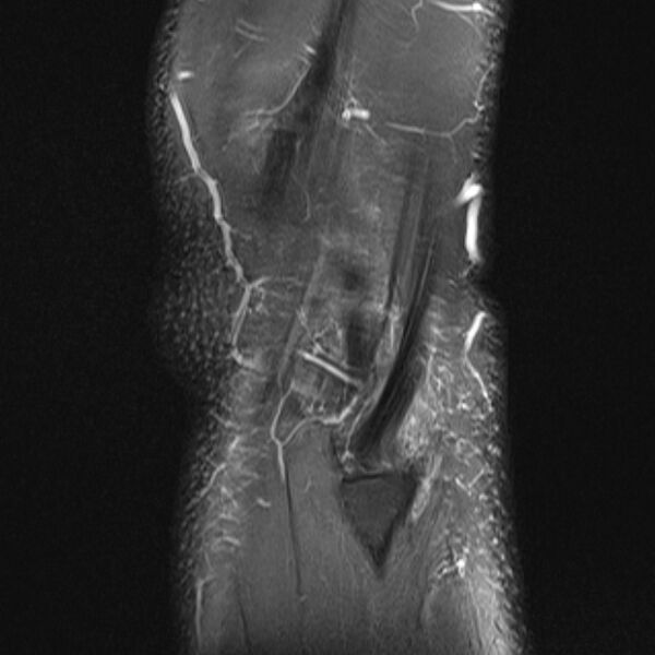 File:Anterior cruciate ligament tear - ramp lesion (Radiopaedia 71883-82322 Sagittal PD fat sat 2).jpg