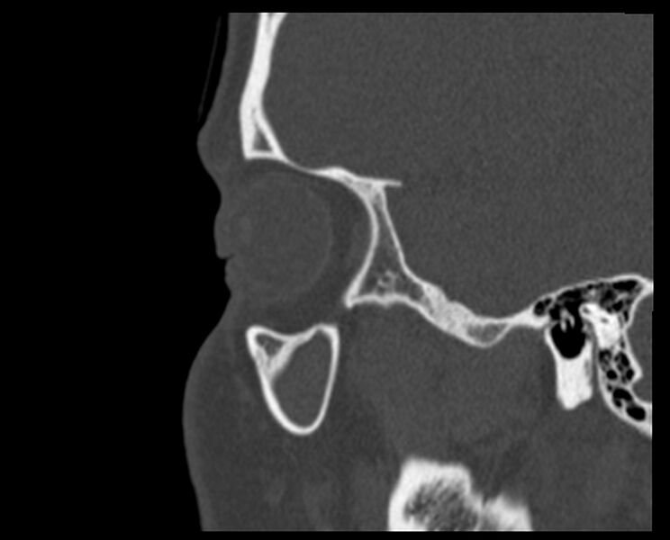 File:Antrochoanal polyp (Radiopaedia 21894-21868 Sagittal bone window 3).jpg