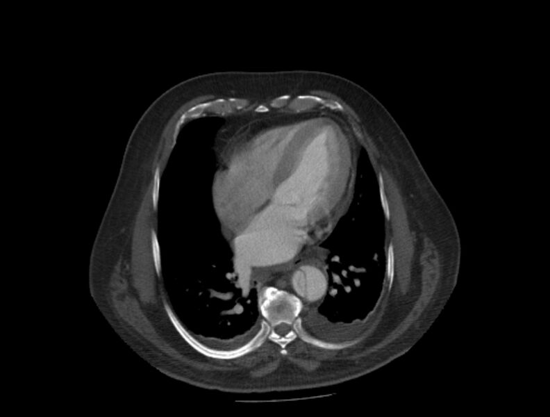 File:Aortic dissection (Radiopaedia 28802-29105 A 27).jpg