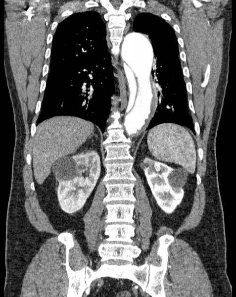 File:Aortic dissection (Radiopaedia 44411-48061 A 44).jpg