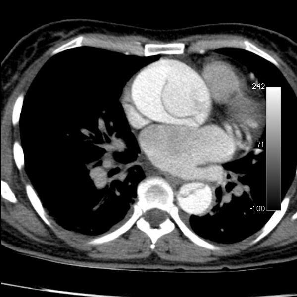 File:Aortic dissection - Stanford type A (Radiopaedia 29247-29659 A 45).jpg