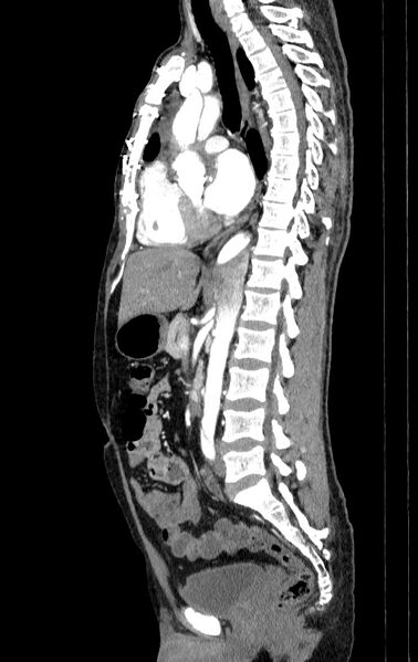 File:Aortic dissection - Stanford type A (Radiopaedia 83418-98500 B 36).jpg