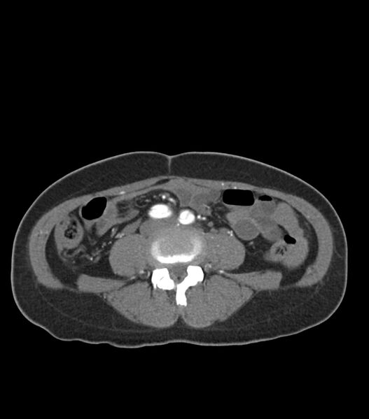 File:Aortic dissection with renal ischemia (Radiopaedia 76573-88338 A 86).jpg