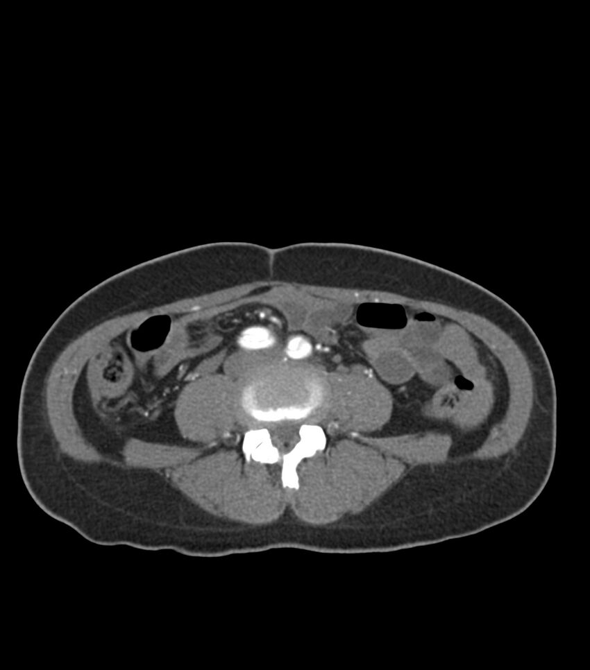 Aortic dissection with renal ischemia (Radiopaedia 76573-88338 A 86).jpg