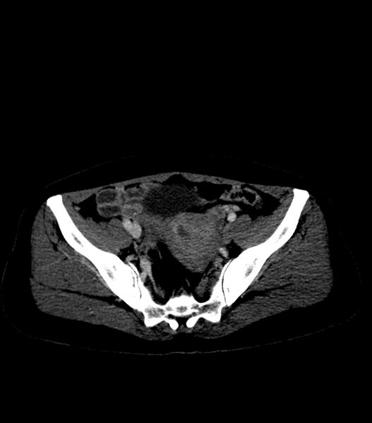 File:Aortic dissection with renal ischemia (Radiopaedia 76573-88338 B 54).jpg