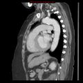 Aortic valve stenosis (Radiopaedia 14480-14423 B 9).jpg