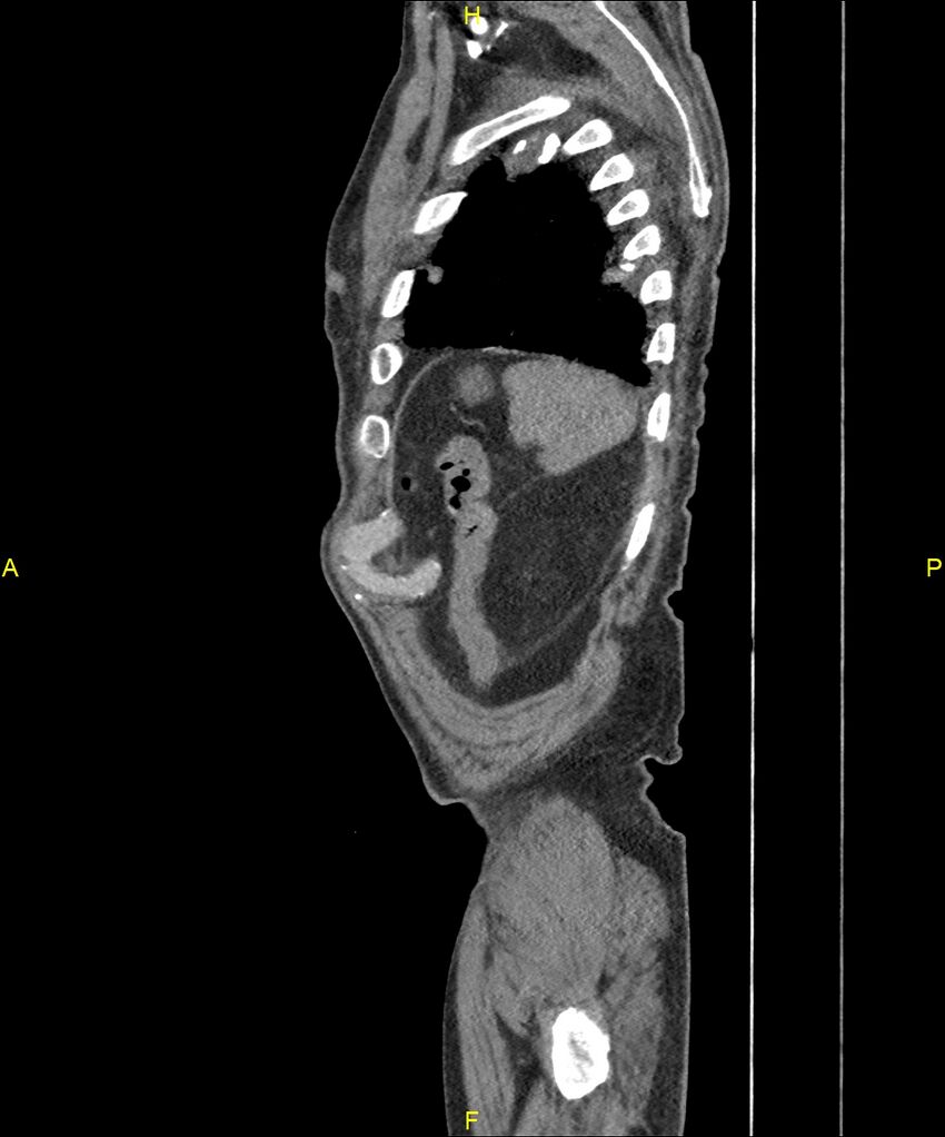 Aortoenteric fistula (Radiopaedia 84308-99603 C 304).jpg