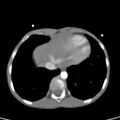 Aortopulmonary window, interrupted aortic arch and large PDA giving the descending aorta (Radiopaedia 35573-37074 B 76).jpg