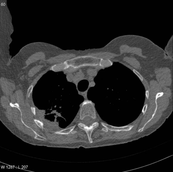 File:Apical non-small-cell lung cancer (Radiopaedia 8570-9405 Axial non-contrast 8).jpg