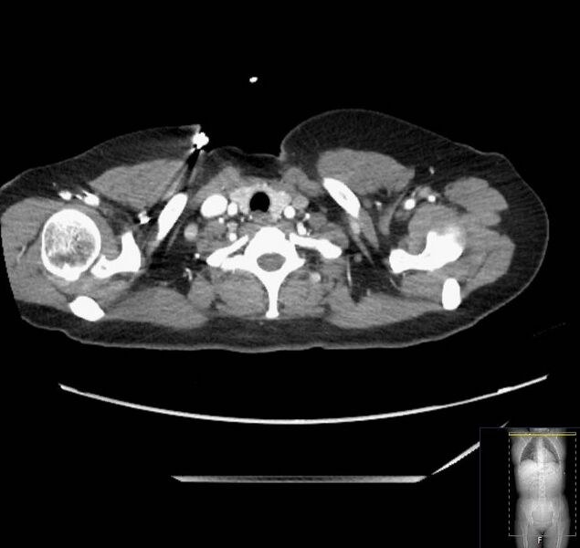 File:Appendicitis (CT angiogram) (Radiopaedia 154713-127660 Axial 242).jpg