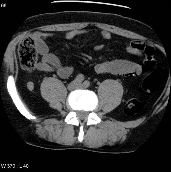 File:Appendicitis (Radiopaedia 12510-12733 Axial non-contrast 30).jpg