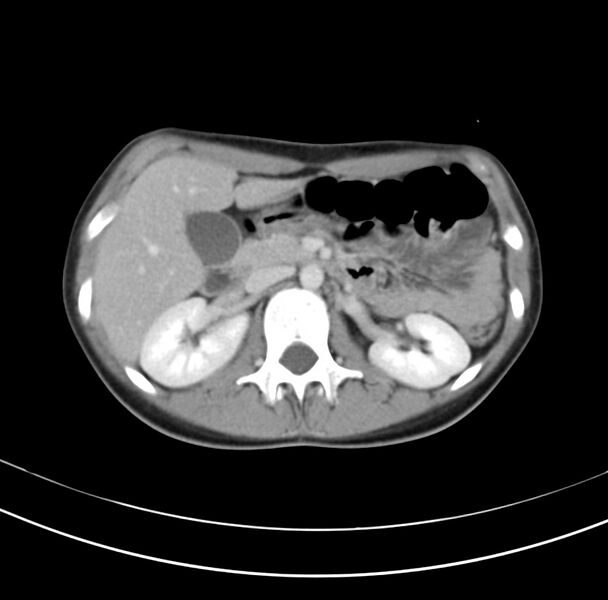 File:Appendicitis and incidental bicornuate uterus (Radiopaedia 22833-22853 B 15).jpg