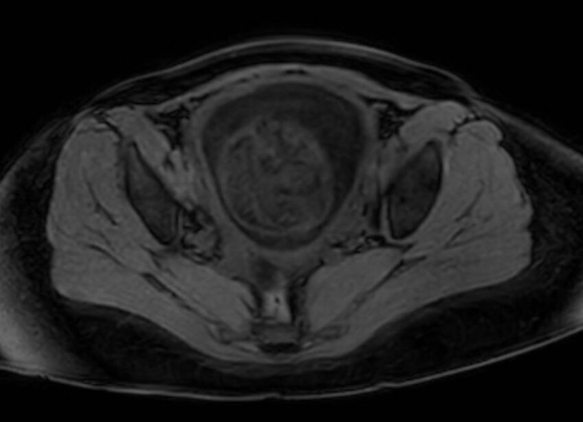 Appendicitis in gravida (MRI) (Radiopaedia 89433-106395 Axial DIXON 127).jpg