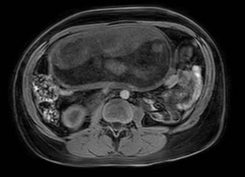 File:Appendicitis in gravida (MRI) (Radiopaedia 89433-106395 Axial DIXON 66).jpg
