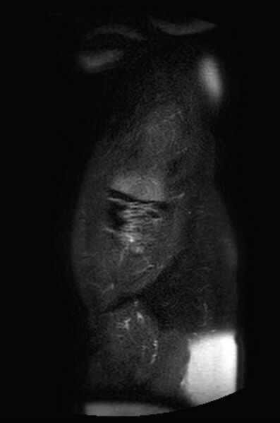 File:Appendicitis in gravida (MRI) (Radiopaedia 89433-106395 Sagittal T2 SPAIR 58).jpg