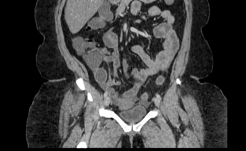 Appendix mucocele (Radiopaedia 41222-44033 B 29).jpg