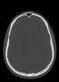 Arrow injury to the head (Radiopaedia 75266-86388 Axial bone window 85).jpg