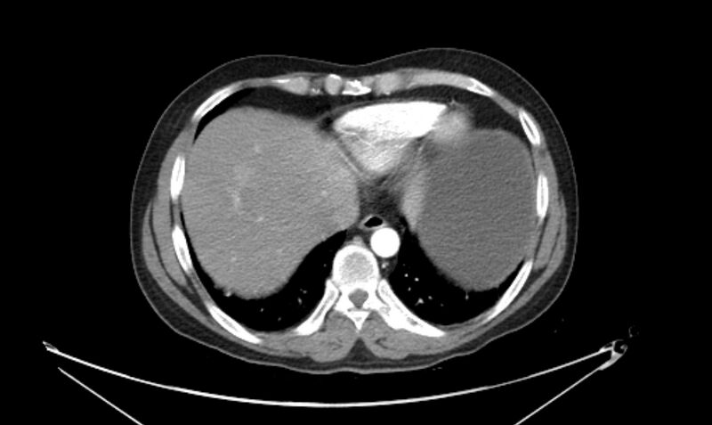 File:Arterial occlusive mesenteric ischemia (Radiopaedia 84641-100060 A 19).jpg