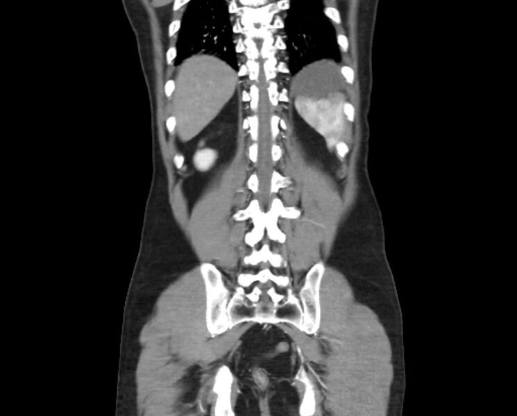 File:Arterial occlusive mesenteric ischemia (Radiopaedia 84641-100060 B 45).jpg