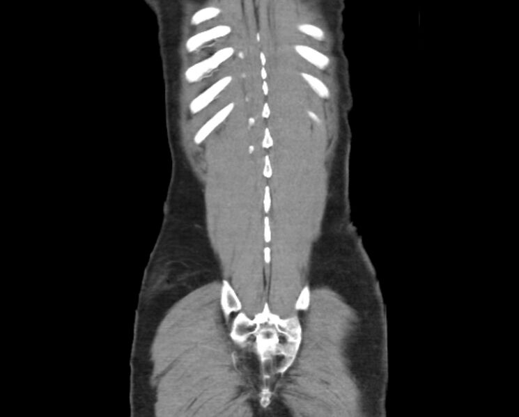 File:Arterial occlusive mesenteric ischemia (Radiopaedia 84641-100060 B 51).jpg