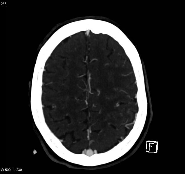 File:Arteriovenous malformation - cerebral (Radiopaedia 8172-14682 A 13).jpg