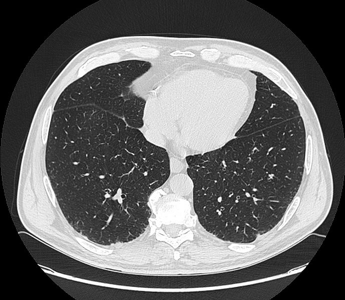 File:Asbestos pleural placques (Radiopaedia 57905-64872 Axial lung window 173).jpg