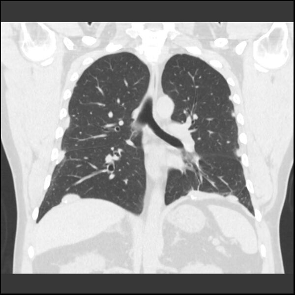 File:Asbestosis (Radiopaedia 45002-48961 Coronal lung window 1).jpg