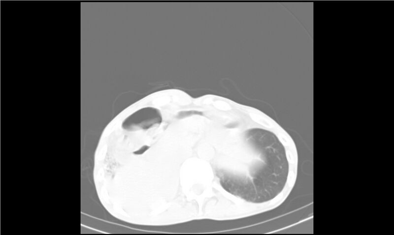 File:Aspergilloma (Radiopaedia 20788-20701 Axial lung window 37).jpg