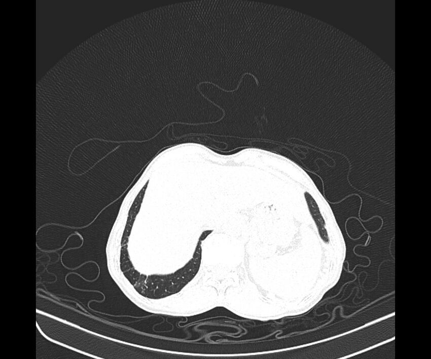 Aspergillomas (Radiopaedia 66779-76110 Axial lung window 45).jpg