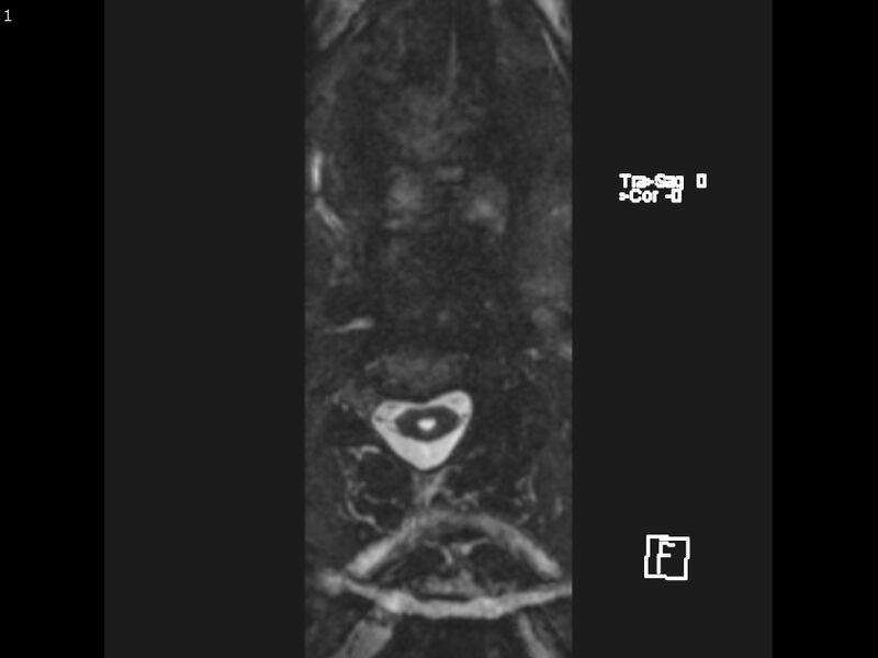 File:Atypical meningioma - intraosseous (Radiopaedia 64915-74572 Axial CISS 1).jpg