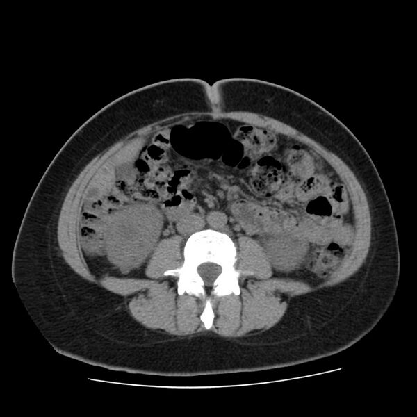 File:Autosomal dominant polycystic kidney disease (Radiopaedia 23061-23093 Axial non-contrast 37).jpg