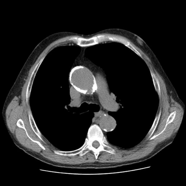 File:Autosomal dominant polycystic kidney disease (Radiopaedia 27851-28094 Axial non-contrast 22).jpg