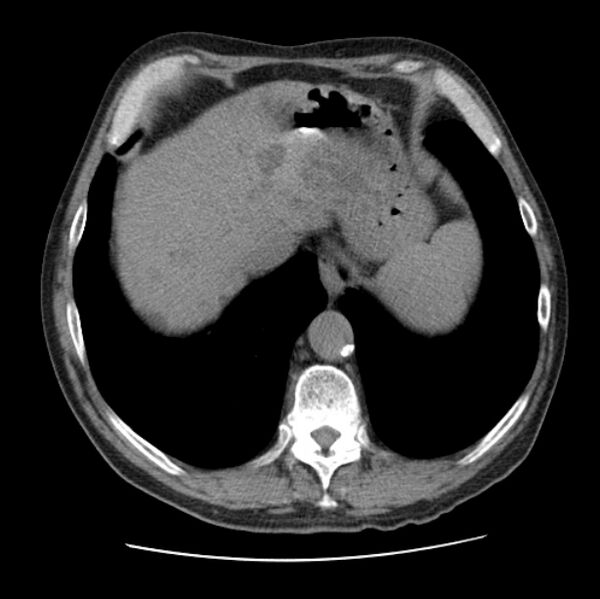 File:Autosomal dominant polycystic kidney disease (Radiopaedia 27851-28094 Axial non-contrast 47).jpg