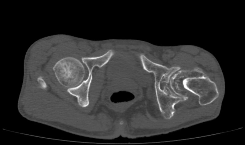 File:Avascular necrosis of the left hip (Radiopaedia 75068-86125 Axial bone window 64).jpg