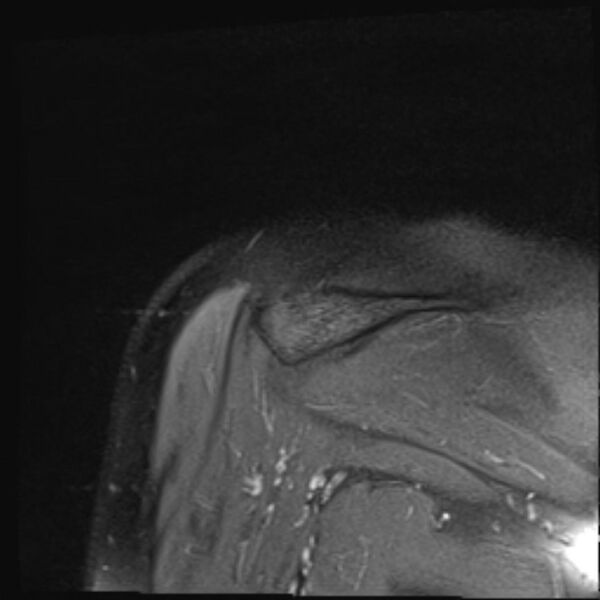 File:Avulsion fracture - greater tuberosity of humerus (Radiopaedia 71216-81515 Coronal PD fat sat 3).jpg