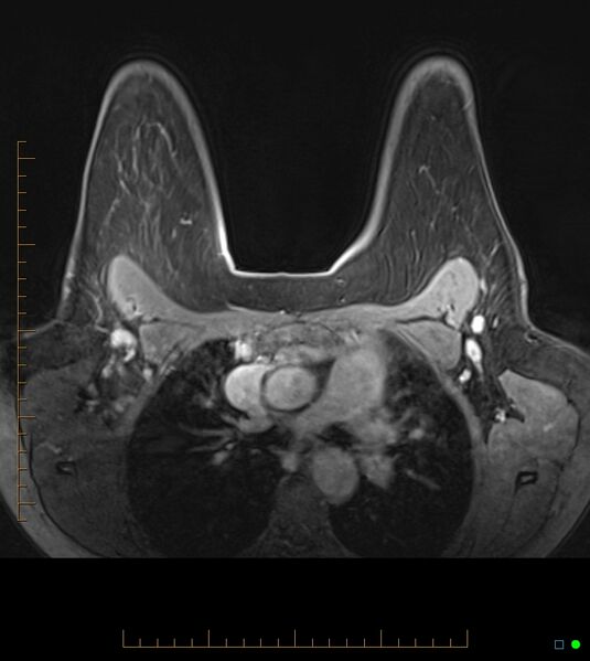 File:Axillary lymphadenopathy on breast MRI- yellow fever vaccination induced (Radiopaedia 19454-19483 Axial T1 C+ fat sat 29).jpg